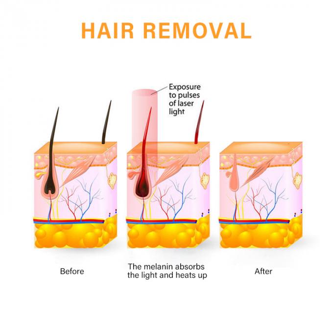 Remoção profissional do cabelo do laser do diodo do alexandrite 808 da depilação da remoção do cabelo da máquina do laser